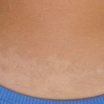 O tipo de câncer mais comum é o de pele,  mas mudanças comportamentais simples ajudam a preveni-lo