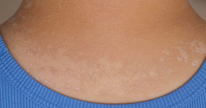 cancer-de-pele O tipo de câncer mais comum é o de pele,  mas mudanças comportamentais simples ajudam a preveni-lo