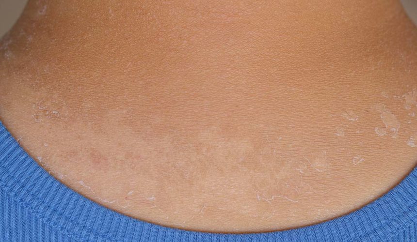 O tipo de câncer mais comum é o de pele,  mas mudanças comportamentais simples ajudam a preveni-lo