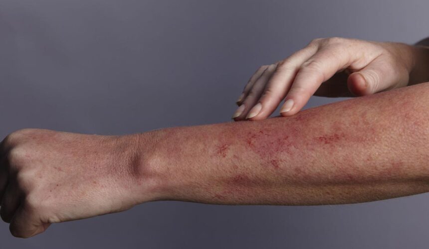 A “marca da borboleta” na face é apenas um dos indícios de que a pessoa tem lúpus