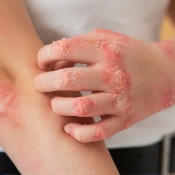 Design sem nome (16) Crônico, lúpus precisa de tratamento individualizado para evitar complicações