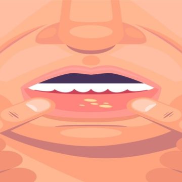 ilustracao-de-estomatite-de-design-plano_23-2150093703 (1) Cuidado com a saúde: muitas doenças do corpo podem começar na boca