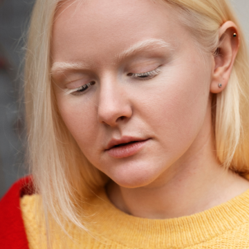 Albinismo é genético e diminui a pigmentação da pele, cabelo e olhos