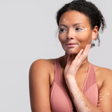 Causando manchas e perda de pigmentação da pele,  vitiligo não é contagioso