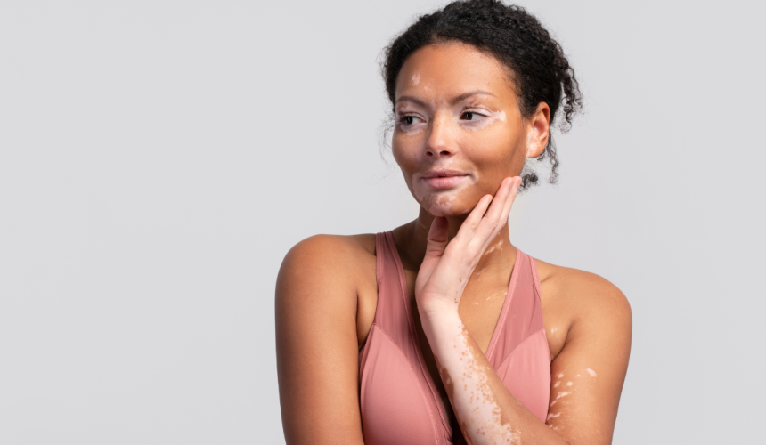 Causando manchas e perda de pigmentação da pele,  vitiligo não é contagioso