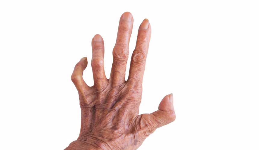 hanseníase